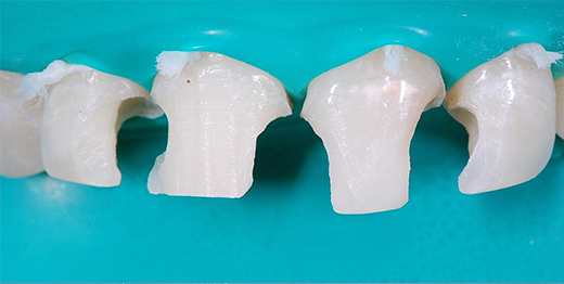 Antes: Quatro Facetas Anteriores